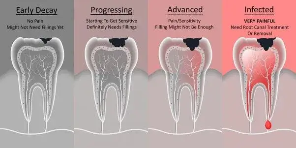 Can You Reverse Tooth Decay Naturally?