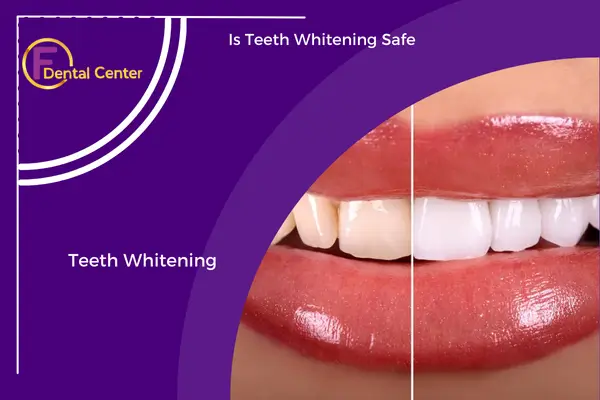 Is Teeth Whitening Safe? Everything You Need to Know
