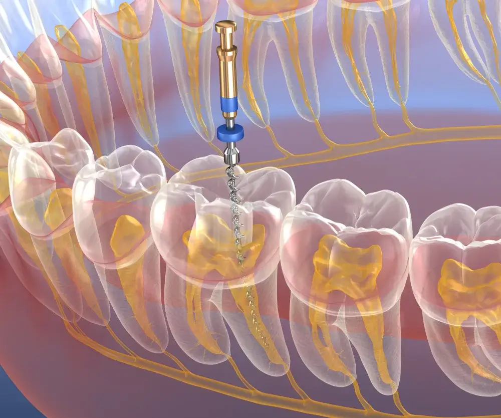 Root canal