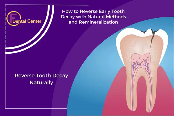 Can You Reverse Tooth Decay Naturally?