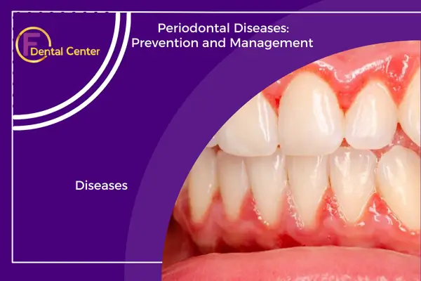 Periodontal Diseases: Prevention and Management at FDental Center