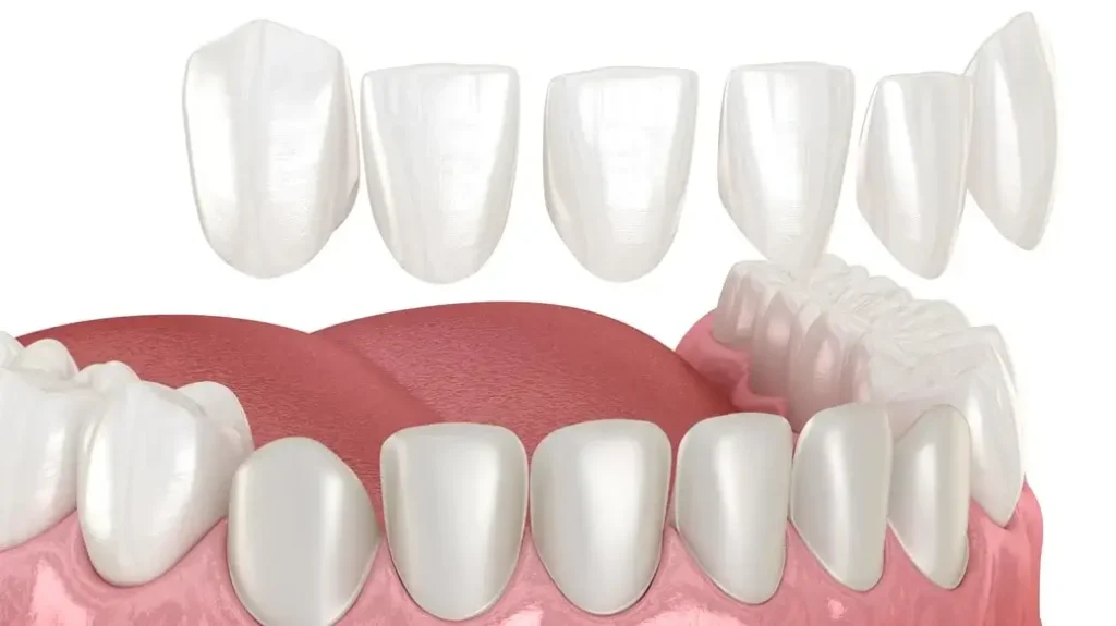 Porcelain Veneers: The Cosmetic Dentistry Solution for a Stunning Smile
