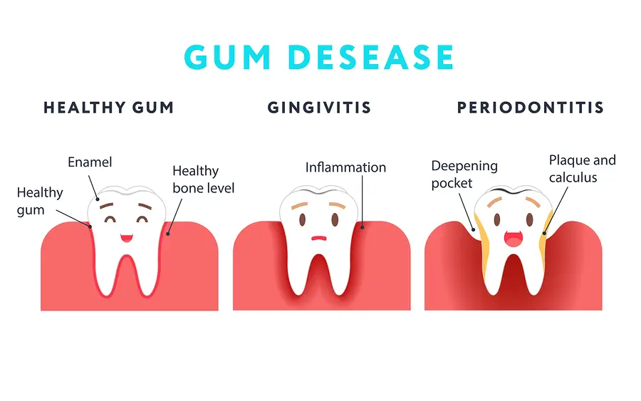 This image has an empty alt attribute; its file name is gum-disease-1-1.webp