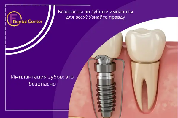 Зубные имплантаты
