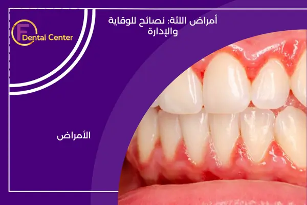 أمراض اللثة: نصائح للوقاية والإدارة