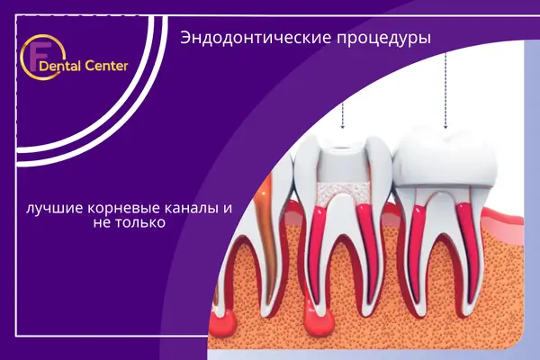 Эндодонтические процедуры: лучшие корневые каналы и не только