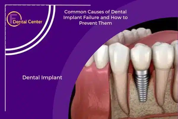 Common Causes of Dental Implant Failure and How to Prevent Them