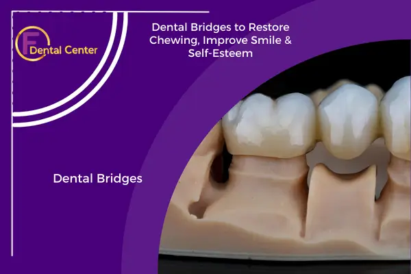 Dental Bridges: Restoring Function and Confidence with Precision