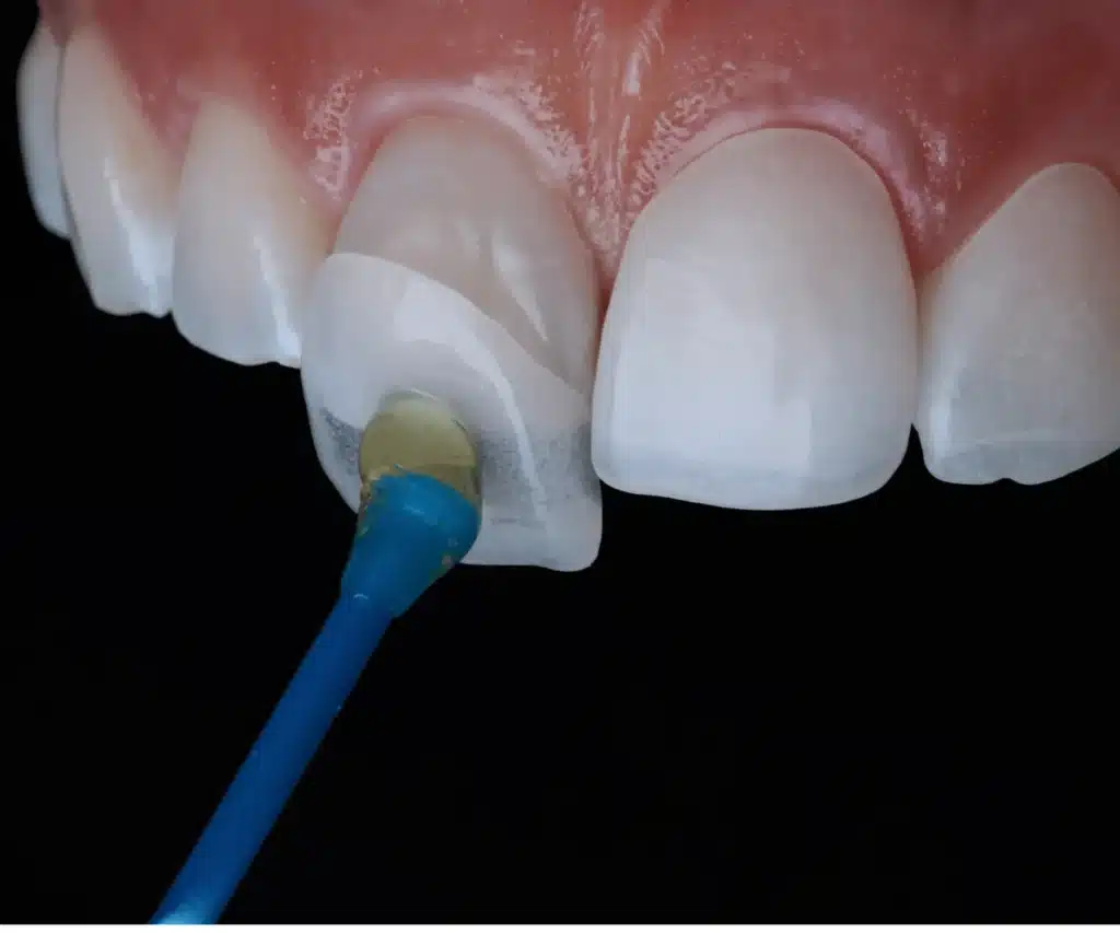 Dental Veneers: Common Issues and How to Avoid Them Effectively