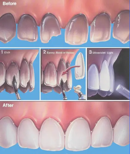 Dental Veneers: The Complete Guide to a Beautiful Smile