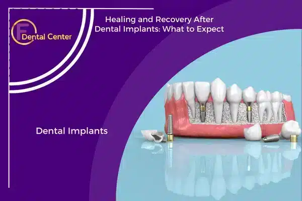 Healing and Recovery After Dental Implants: What to Expect
