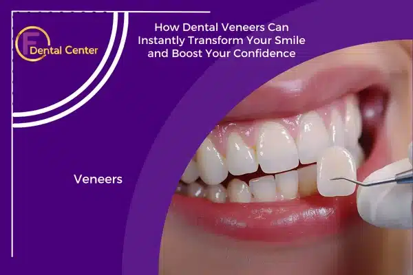 How Dental Veneers Can Instantly Transform Your Smile and Boost Your Confidence