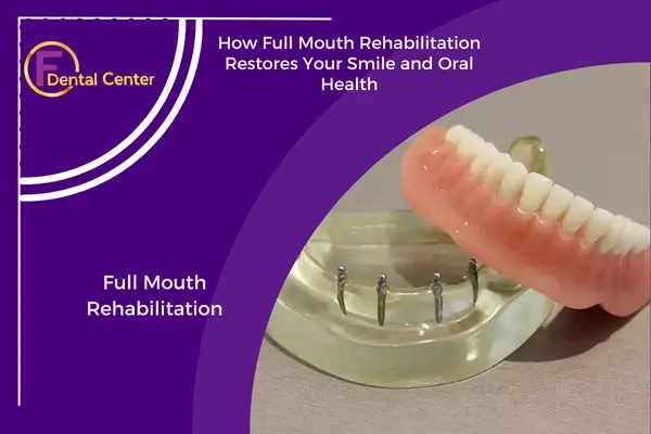 Full Mouth Rehabilitation: Restoring Oral Health and Function