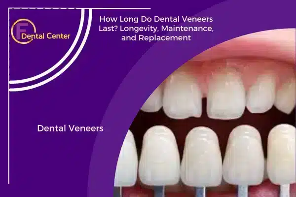 How Long Do Dental Veneers Last