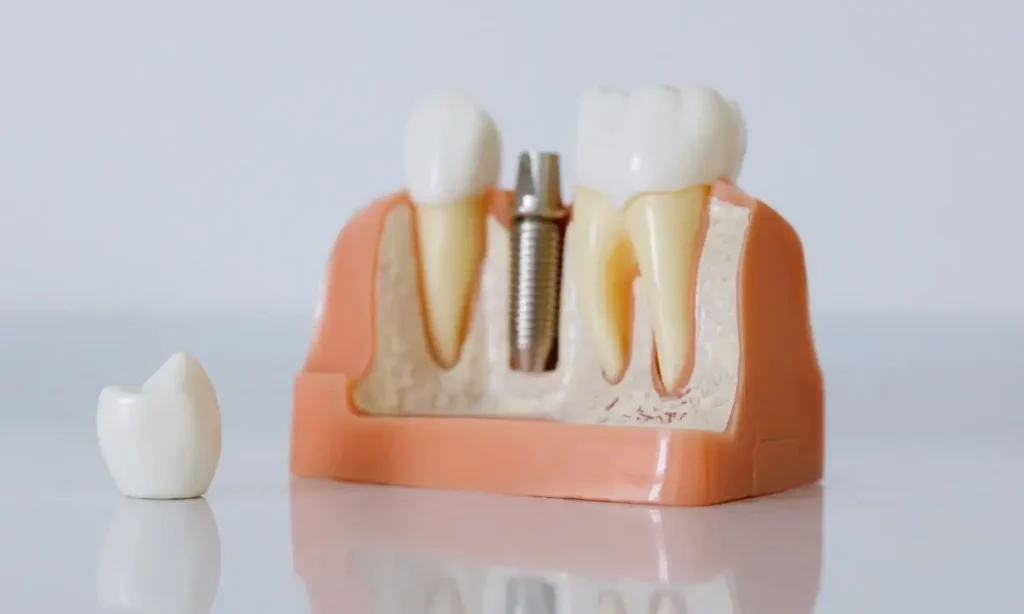 Implant Care: Essential Tips to Protect Your Dental Investment