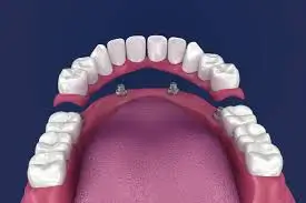 Implant-Supported Dentures: A Secure and Modern Solution for Tooth Loss