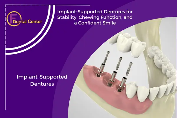 Implant-Supported Dentures: A Secure and Modern Solution for Tooth Loss
