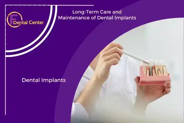 Long-Term Care and Maintenance of Dental Implants
