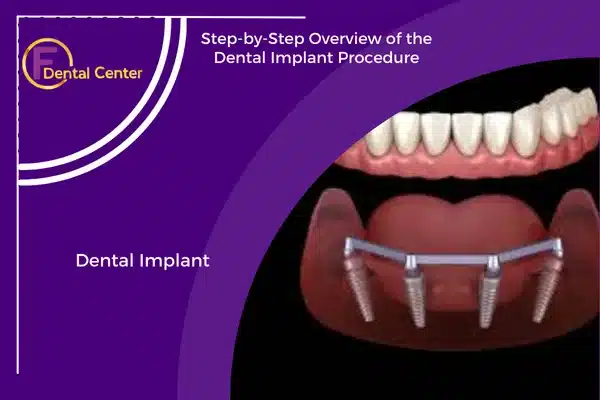 Step-by-Step Overview of the Dental Implant Procedure