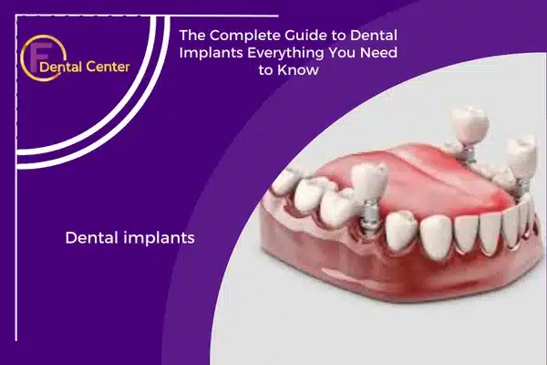 The Complete Guide to Dental Implants: Everything You Need to Know