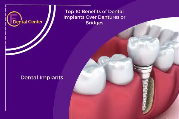 Top 10 Benefits of Dental Implants Over Dentures or Bridges
