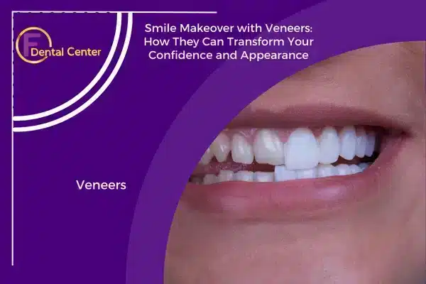 Smile Makeover with Veneers
