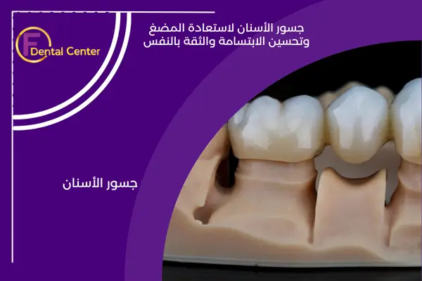 جسور الأسنان: استعادة الوظيفة والثقة مع الدقة