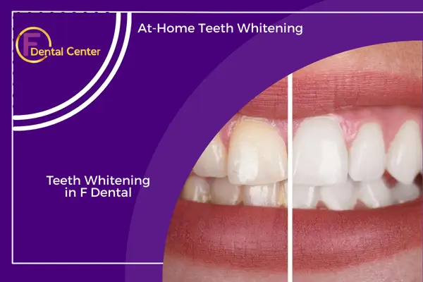 At-Home Teeth Whitening