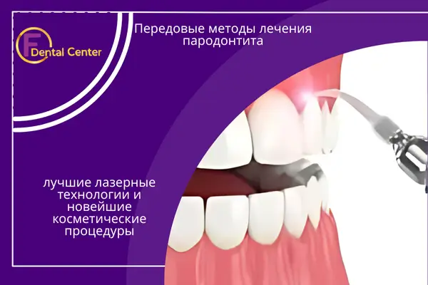 Передовые методы лечения пародонтита - лучшие лазерные технологии и новейшие косметические процедуры