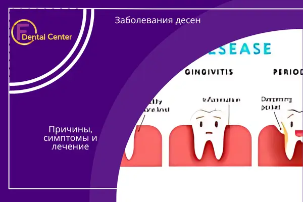 Заболевания десен: Причины, симптомы и лечение