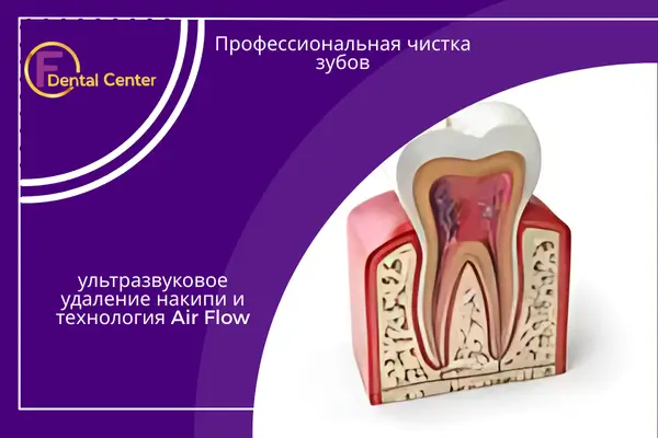 Профессиональная чистка зубов - ультразвуковое удаление накипи и технология Air Flow