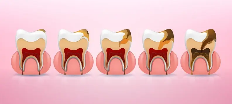 Common Dental Diseases: Everything You Should Know to Stay Protected
