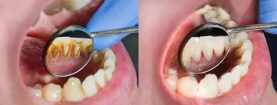 Common Dental Diseases: Everything You Should Know to Stay Protected