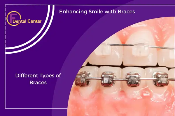 Transforming Your Smile with Braces for Teeth