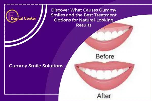 Gummy Smile: What Causes It and How It’s Treated