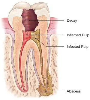 Endodontic Therapy