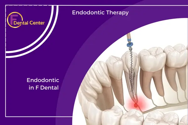 Endodontic-Therapy