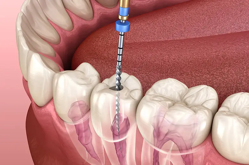 Root Canal Treatment: How Endodontics Helps Save Your Natural Teeth