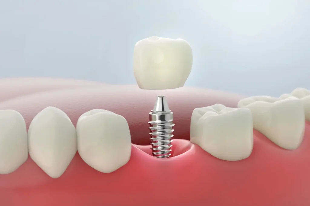 Everything You Need to Know About Tooth Replacement