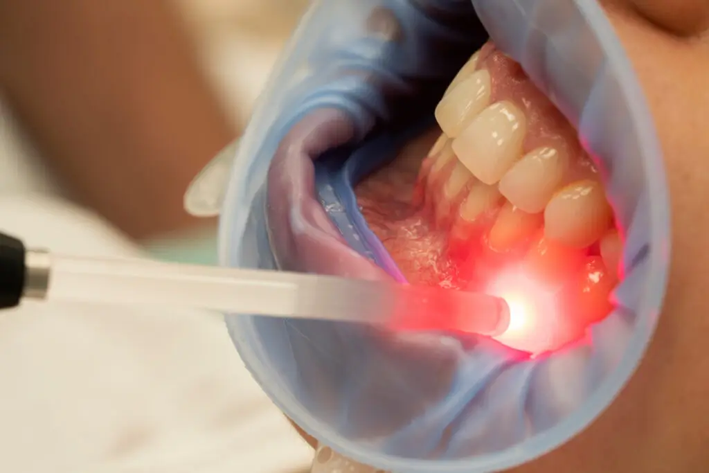 Gum Disease Treatment with Laser Technology: Revolutionizing Periodontal Care