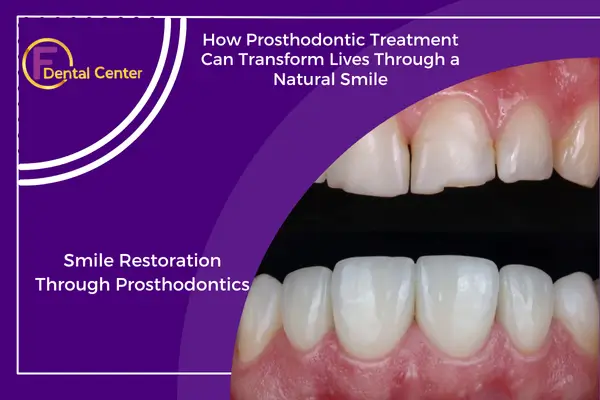 Prosthodontic Treatment: The Path to Complete Smile Restoration