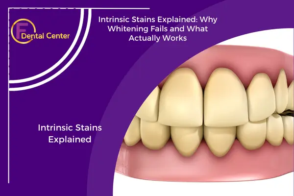 Intrinsic Stains Explained: Why Whitening Fails and What Actually Works