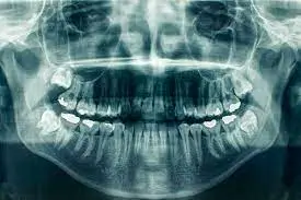 Introduction: Revolutionizing Dentistry with Digital X-Rays