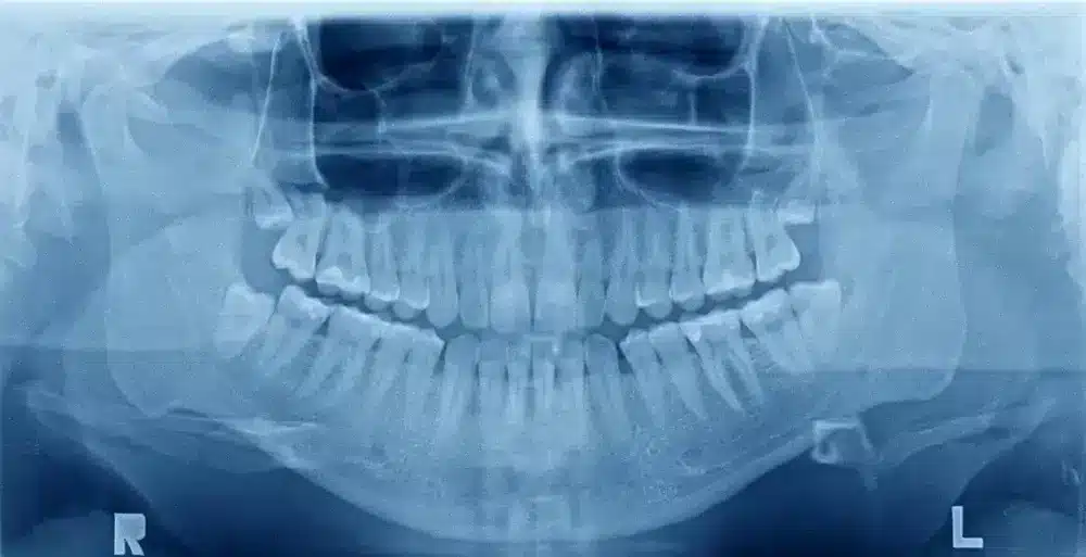 Introduction: Revolutionizing Dentistry with Digital X-Rays