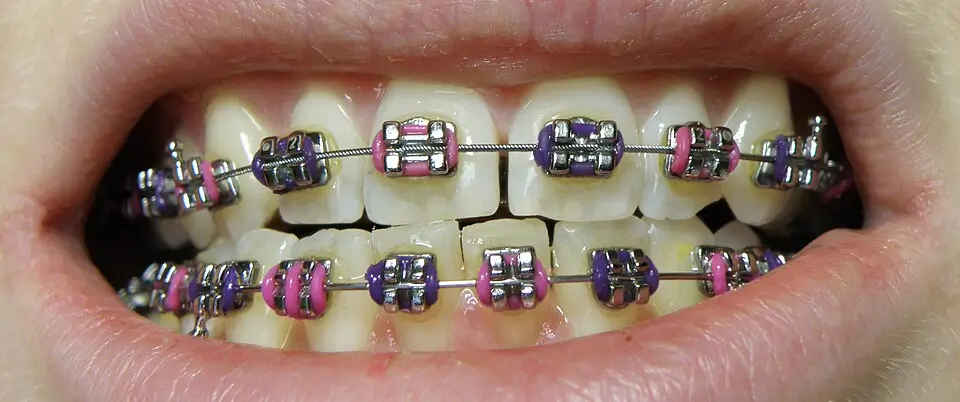 How Orthodontic Treatment Improves Overall Oral Health