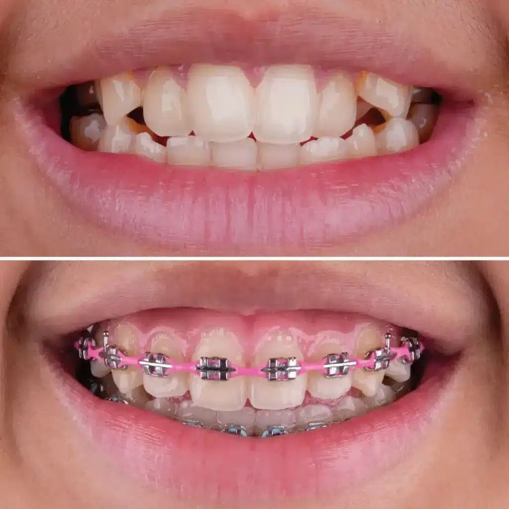 How Orthodontic Treatment Improves Overall Oral Health