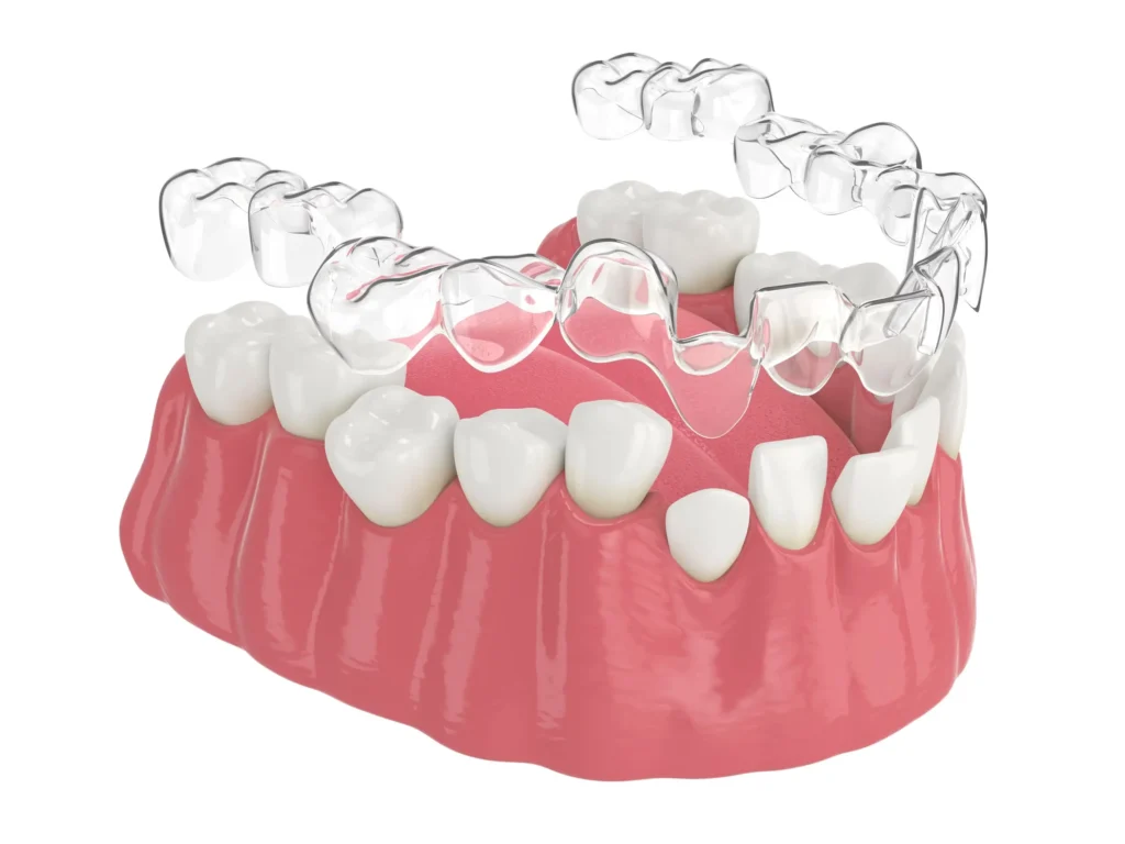 Orthodontic Transparent Aligner