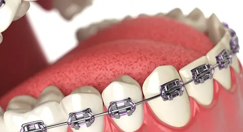 Orthodontic_Treatment