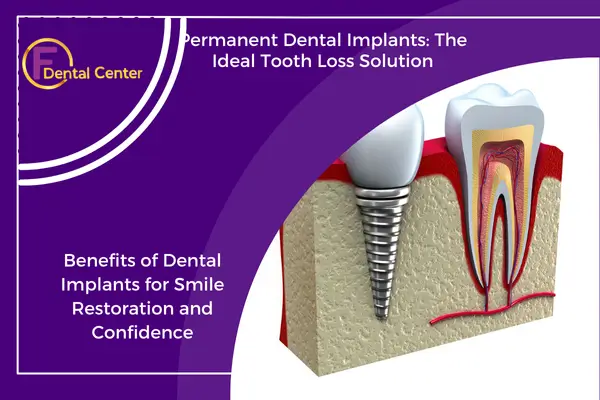 Dental Implants: A Modern Solution for Permanent Tooth Replacement
