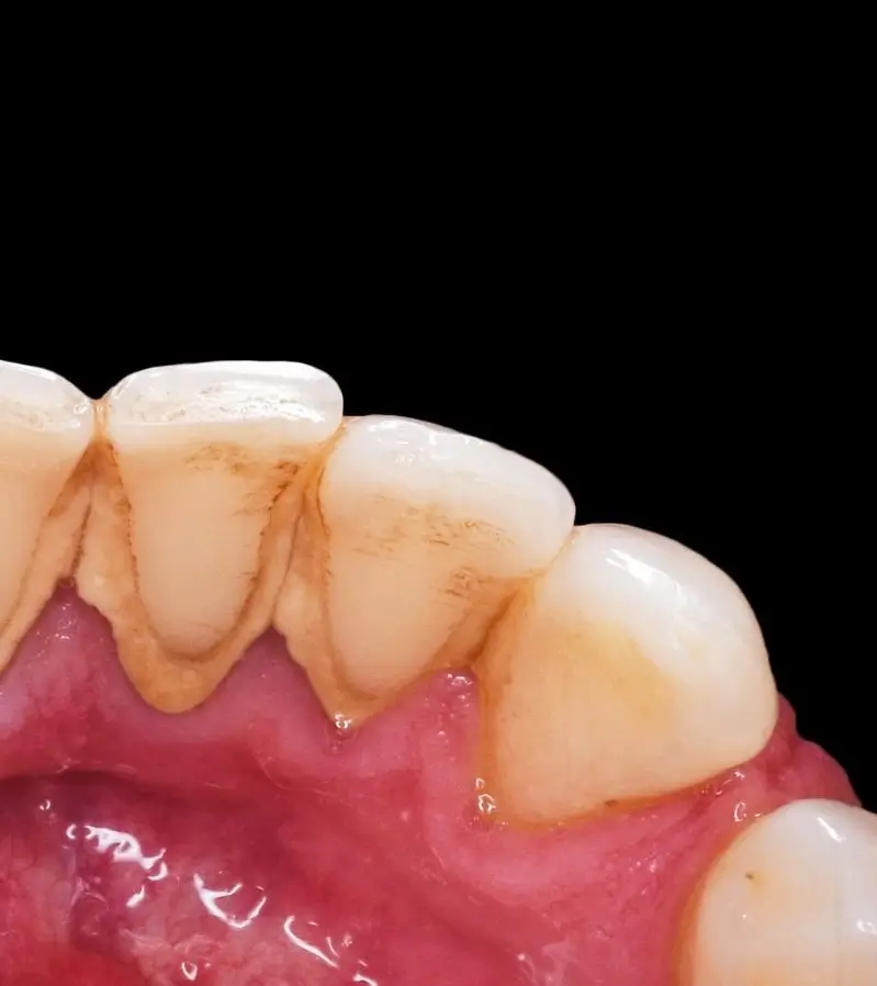 Professional Teeth Cleaning: The Key to a Healthier, Brighter Smile
